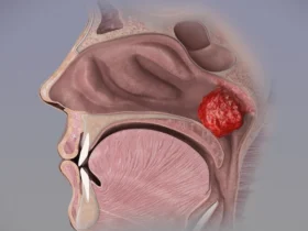 What are adenoids? Can adenoids grow back? Proper treatment for adenoids.