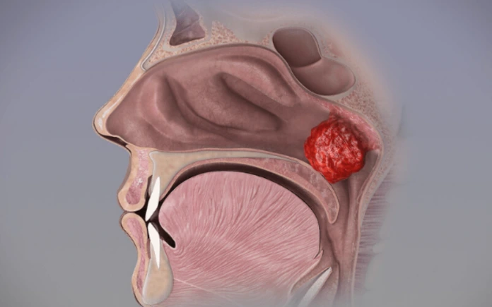 What are adenoids? Can adenoids grow back? Proper treatment for adenoids.